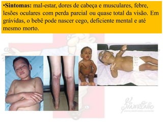 •Sintomas: mal-estar, dores de cabeça e musculares, febre,
lesões oculares com perda parcial ou quase total da visão. Em
grávidas, o bebê pode nascer cego, deficiente mental e até
mesmo morto.
 