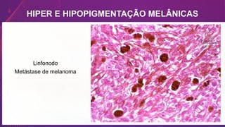 HIPER E HIPOPIGMENTAÇÃO MELÂNICAS
Linfonodo
Metástase de melanoma
 