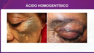 ÁCIDO HOMOGENTÍSICO
 