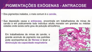 • Dos pigmentos inalados, o mais comum é o carvão.
• Sua deposição causa a antracose, encontrada em trabalhadores de minas de
carvão e em praticamente todo indivíduo adulto morador em grandes ou médias
cidades onde exista certo grau de poluição atmosférica.
PIGMENTAÇÕES EXÓGENAS - ANTRACOSE
Em trabalhadores de minas de carvão, o
grande acúmulo de pigmento nos pulmões
pode acompanhar-se de fibrose e levar a
diminuição da capacidade respiratória
 