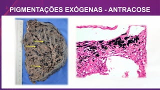 PIGMENTAÇÕES EXÓGENAS - ANTRACOSE
 