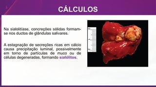 CÁLCULOS
Na sialolitíase, concreções sólidas formam-
se nos ductos de glândulas salivares.
A estagnação de secreções ricas em cálcio
causa precipitação luminal, possivelmente
em torno de partículas de muco ou de
células degeneradas, formando sialólitos.
 
