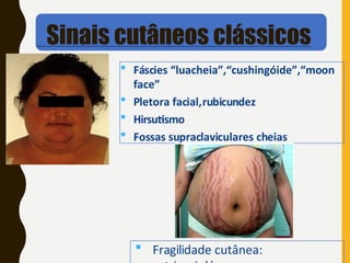  Fáscies “luacheia”,“cushingóide”,“moon
face”
 Pletora facial,rubicundez
 Hirsutismo
 Fossas supraclaviculares cheias
 Fragilidade cutânea:
Sinais cutâneos clássicos
 