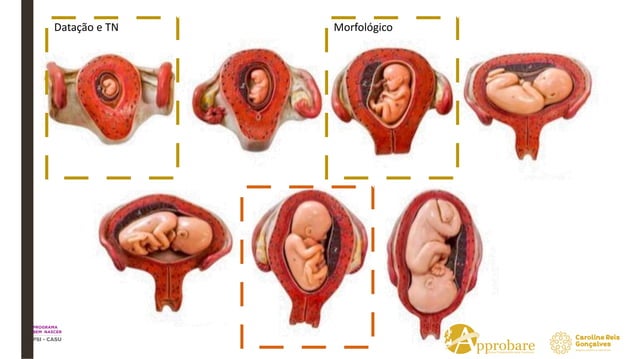 Aula 4 - OBSTETRÍCIA - Alterações fisiológicas da gravidez, gravidez ...
