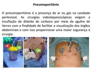 Pneumoperitônio
O pneumoperitônio é a presença de ar ou gás na cavidade
peritoneal. As cirurgias videolaparoscópicas exigem a
insuflação de dióxido de carbono por meio da agulha de
Verres com a finalidade de facilitar a visualização dos órgãos
abdominais e com isso proporcionar uma maior segurança à
cirurgia.
 