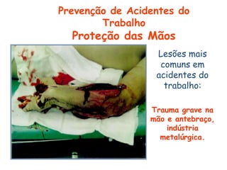 Lesões mais
comuns em
acidentes do
trabalho:
Trauma grave na
mão e antebraço,
indústria
metalúrgica.
Prevenção de Acidentes do
Trabalho
Proteção das Mãos
 