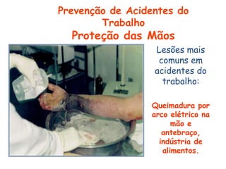 Lesões mais
comuns em
acidentes do
trabalho:
Queimadura por
arco elétrico na
mão e
antebraço,
indústria de
alimentos.
Prevenção de Acidentes do
Trabalho
Proteção das Mãos
 