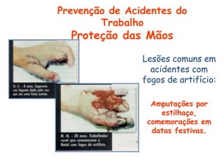 Lesões comuns em
acidentes com
fogos de artifício:
Amputações por
estilhaço,
comemorações em
datas festivas.
Prevenção de Acidentes do
Trabalho
Proteção das Mãos
 
