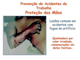 Lesões comuns em
acidentes com
fogos de artifício:
Queimadura por
calor irradiado,
comemorações em
datas festivas.
Prevenção de Acidentes do
Trabalho
Proteção das Mãos
 