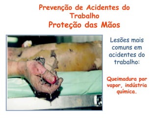 Lesões mais
comuns em
acidentes do
trabalho:
Queimadura por
vapor, indústria
química.
Prevenção de Acidentes do
Trabalho
Proteção das Mãos
 