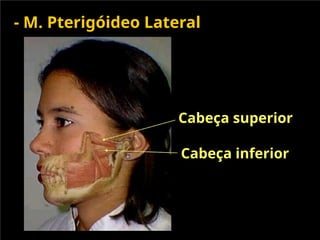 - M. Pterigóideo Lateral
Cabeça superior
Cabeça inferior
 