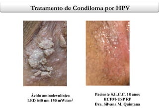 Tratamento de Condiloma por HPV
ANTES DA TFD

Ácido aminolevulínico
LED 640 nm 150 mW/cm2

APÓS 3 SEMANAS

Paciente S.L.C.C. 18 anos
HCFM-USP RP
Dra. Silvana M. Quintana

 