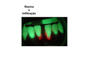 Resina
e
Infiltração

 