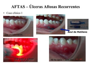 AFTAS – Úlceras Aftosas Recorrentes
•  Caso clínico 1

Azul de Metileno
Dor insuportável.

LED 630 ± 10nm
Dose = 100 J/cm2

48 hs após – sem dor

 
