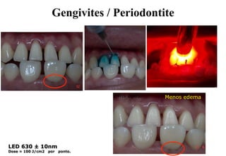 Gengivites / Periodontite

24hs após.

LED 630 ± 10nm
Dose = 100 J/cm2

por

ponto.

Menos edema

 