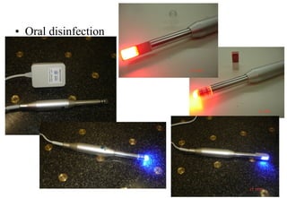 •  Oral disinfection

 