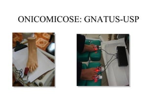 ONICOMICOSE: GNATUS-USP

 