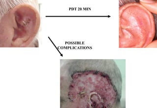 PDT 20 MIN

POSSIBLE
COMPLICATIONS

 