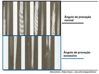Ângulo de pronação normal Ângulo de pronação excessivo 