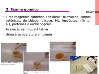 icaClínica2. Exame químico

Tiras reagentes contendo dez áreas: bilirrubina, corpos
cetônicos, densidade, glicose, Hb, leucócitos, nitrito,
pH, proteínas e urobilinogênio.

Avaliação semi-quantitativa

Urina à temperatura ambiente
 