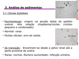 icaClínica3. Análise de sedimentos
3.1 Células Epiteliais

Pavimentosas: origem na porção distal do epitélio
uretral. Alta relação citoplasma/núcleo (núcleo
pequeno e condensado)

Normal: raras

Muitas células: erro de coleta

de transição: Encontram-se desde a pelve renal até a
parte proximal da uretra

Raras: normal. Número aumentado: infecção urinária
15 a 30 µm
20 a 30 µm
 