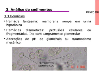 icaClínica
3.3 Hemácias

Hemácia fantasma: membrana rompe em urina
hipotônica

Hemácias dismórficas: protusões celulares ou
fragmentadas. Indicam sangramento glomerular

Alterações de pH do glomérulo ou traumatismo
mecânico
3. Análise de sedimentos
 
