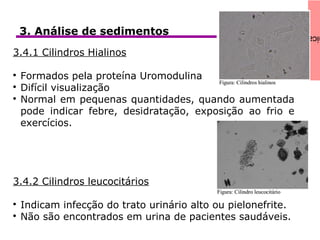 icaClínica3. Análise de sedimentos
3.4.1 Cilindros Hialinos

Formados pela proteína Uromodulina

Difícil visualização

Normal em pequenas quantidades, quando aumentada
pode indicar febre, desidratação, exposição ao frio e
exercícios.
3.4.2 Cilindros leucocitários

Indicam infecção do trato urinário alto ou pielonefrite.

Não são encontrados em urina de pacientes saudáveis.
 