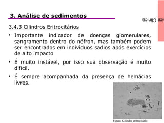 icaClínica3. Análise de sedimentos
3.4.3 Cilindros Eritrocitários

Importante indicador de doenças glomerulares,
sangramento dentro do néfron, mas também podem
ser encontrados em indivíduos sadios após exercícios
de alto impacto

É muito instável, por isso sua observação é muito
difícil.

É sempre acompanhada da presença de hemácias
livres.
 