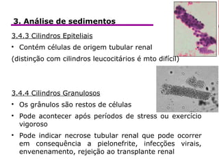 icaClínica3. Análise de sedimentos
3.4.3 Cilindros Epiteliais

Contém células de origem tubular renal
(distinção com cilindros leucocitários é mto difícil)
3.4.4 Cilindros Granulosos

Os grânulos são restos de células

Pode acontecer após períodos de stress ou exercício
vigoroso

Pode indicar necrose tubular renal que pode ocorrer
em consequência a pielonefrite, infecções virais,
envenenamento, rejeição ao transplante renal
 