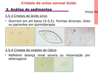 icaClínica3. Análise de sedimentos
3.5.3 Cristais de ácido úrico

Ocorrem em pH baixo (5-5,5). Formas diversas. Gota
ou pacientes em quimioterapia
3.5.4 Cristais de oxalato de Cálcio

Refletem doença renal severa ou intoxicação por
etilenoglicol
Cristais de urina normal ácida
 