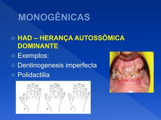  HAD – HERANÇA AUTOSSÔMICA
DOMINANTE
 Exemplos:
 Dentinogenesis imperfecta
 Polidactilia
 