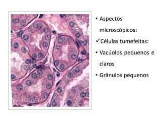 • Aspectos
microscópicos:
Células tumefeitas:
• Vacúolos pequenos e
claros
• Grânulos pequenos
 