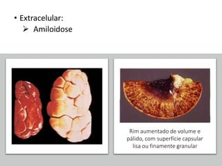 • Extracelular:
 Amiloidose
Rim aumentado de volume e
pálido, com superfície capsular
lisa ou finamente granular
 