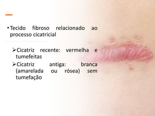 •Tecido fibroso relacionado ao
processo cicatricial
Cicatriz recente: vermelha e
tumefeitas
Cicatriz antiga: branca
(amarelada ou rósea) sem
tumefação
 