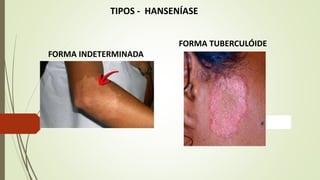 TIPOS - HANSENÍASE
FORMA INDETERMINADA
FORMA TUBERCULÓIDE
 