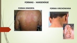 FORMAS - HANSENÍASE
FORMA DIMORFA FORMA VIRCHOWIANA
 