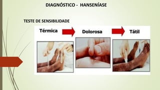 DIAGNÓSTICO - HANSENÍASE
TESTE DE SENSIBILIDADE
 