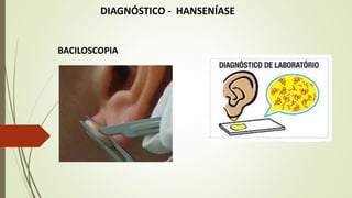 DIAGNÓSTICO - HANSENÍASE
BACILOSCOPIA
 