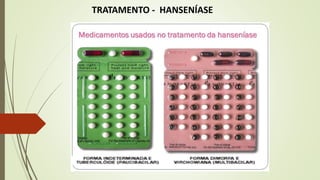 TRATAMENTO - HANSENÍASE
 