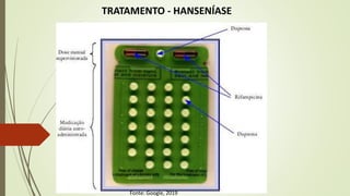 TRATAMENTO - HANSENÍASE
Fonte: Google, 2019
 