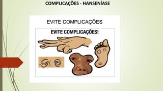 COMPLICAÇÕES - HANSENÍASE
 