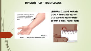 DIAGNÓSTICO – TUBERCULOSE
LEITURA: 72 A 96 HORAS:
DE O A 4mm: não reator
DE 5 A 9mm: reator fraco
10 mm a mais: reator forte
 