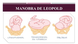 MANOBRA DE LEOPOLD
 