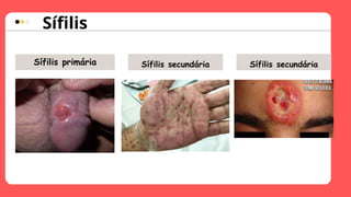 Sífilis
 