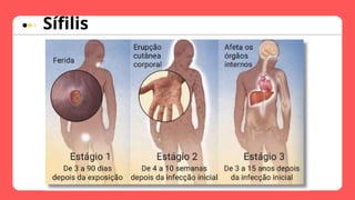 Sífilis
 