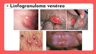 Linfogranuloma venéreo
 