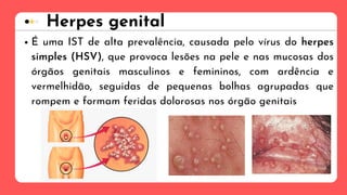 Herpes genital
É uma IST de alta prevalência, causada pelo vírus do herpes
simples (HSV), que provoca lesões na pele e nas mucosas dos
órgãos genitais masculinos e femininos, com ardência e
vermelhidão, seguidas de pequenas bolhas agrupadas que
rompem e formam feridas dolorosas nos órgão genitais
 
