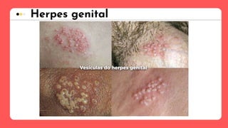 Herpes genital
 
