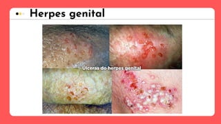 Herpes genital
 