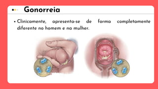 Gonorreia
Clinicamente, apresenta-se de forma completamente
diferente no homem e na mulher.
 